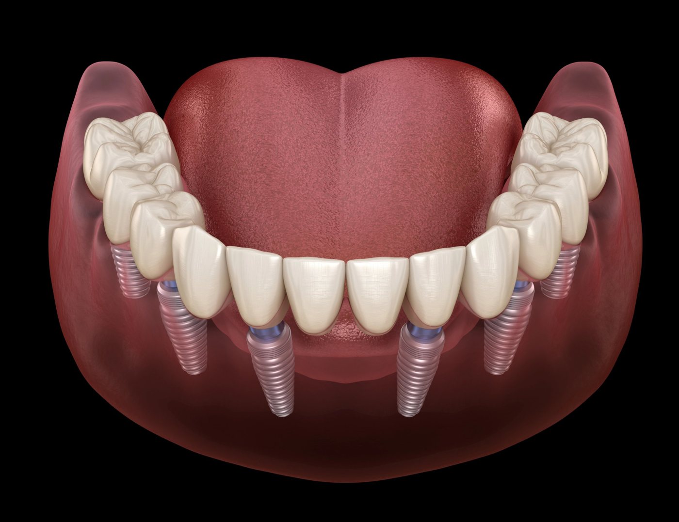 Illustration of a lower full-arch bridge attached to six implants